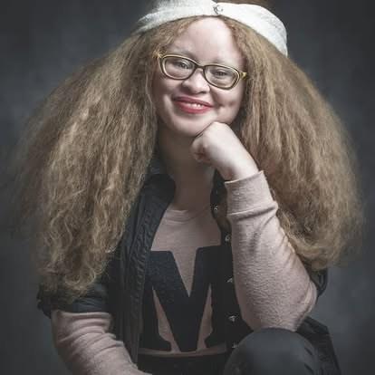 A portrait of a young woman with albinism.