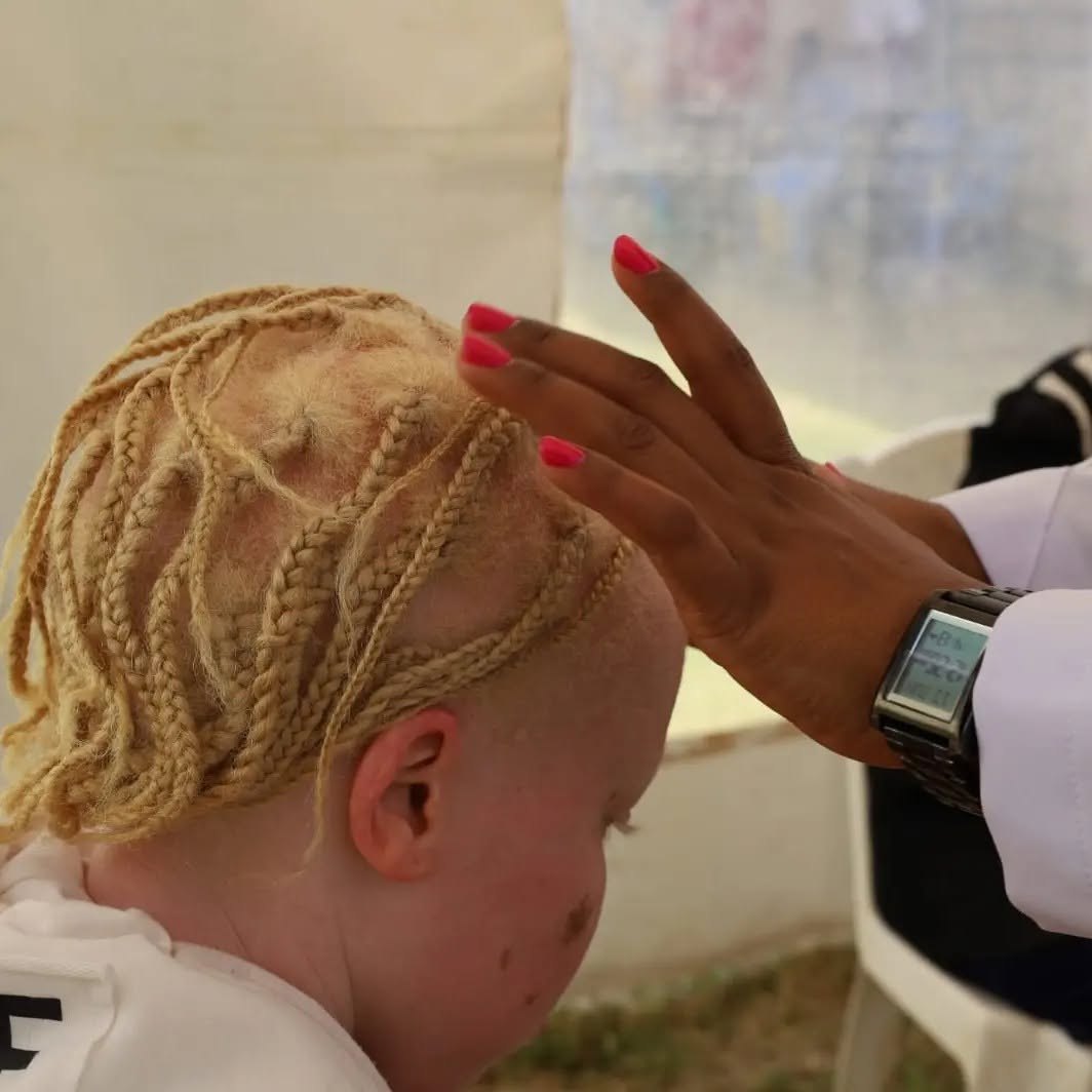 Sun cream being smoothed onto the head of a young child with albinism.